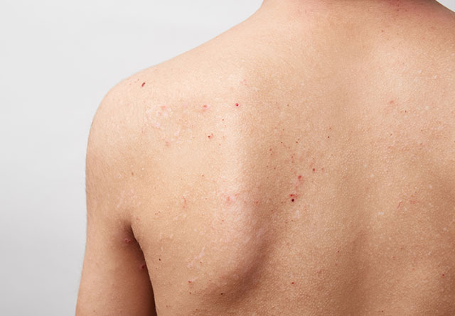 アレルギー 化繊 化学繊維が起こす肌トラブルの危険性